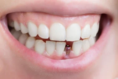 https://jalaramdentalclinics.com/wp-content/uploads/2022/09/2022-06-18-5.webp