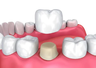 https://jalaramdentalclinics.com/wp-content/uploads/2022/09/2022-06-18-7.webp