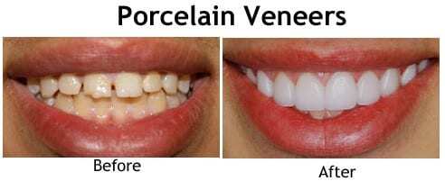 Porcelain Veneers Science City