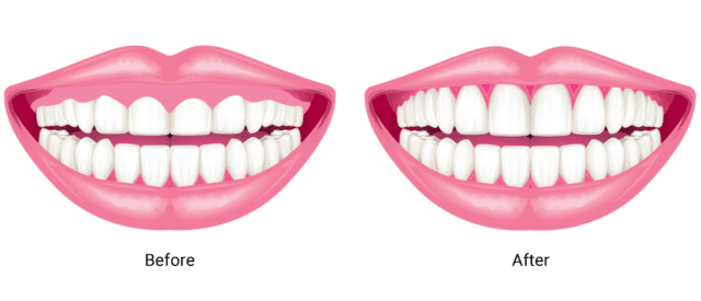 Gum Contouring Treatment in Science City