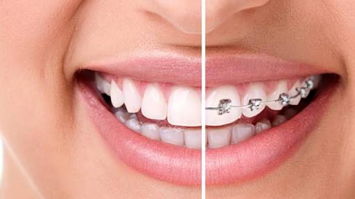 braces-1