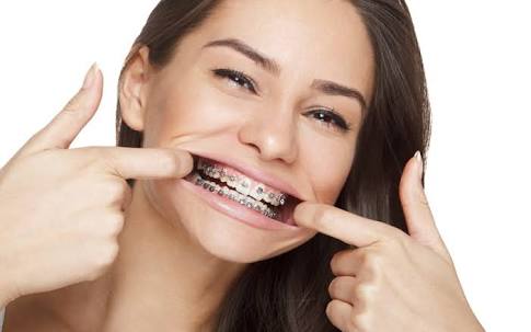 braces-2