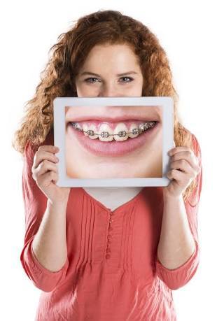 braces-3