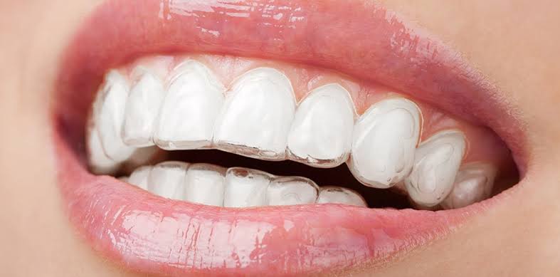 dental aligner -1