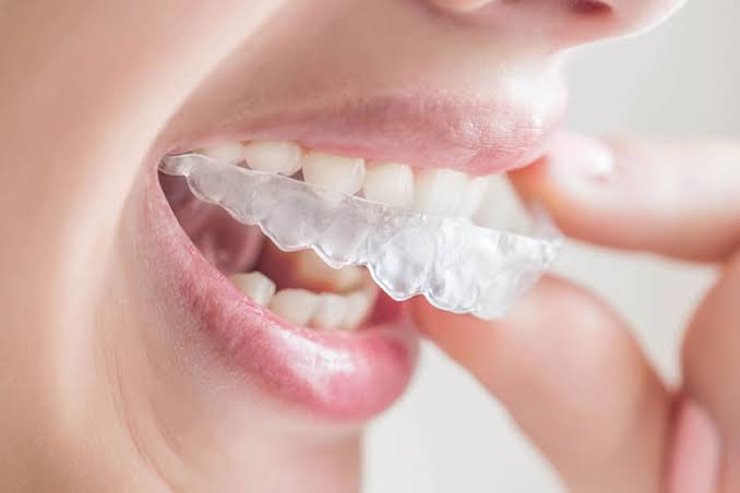 dental aligner -2