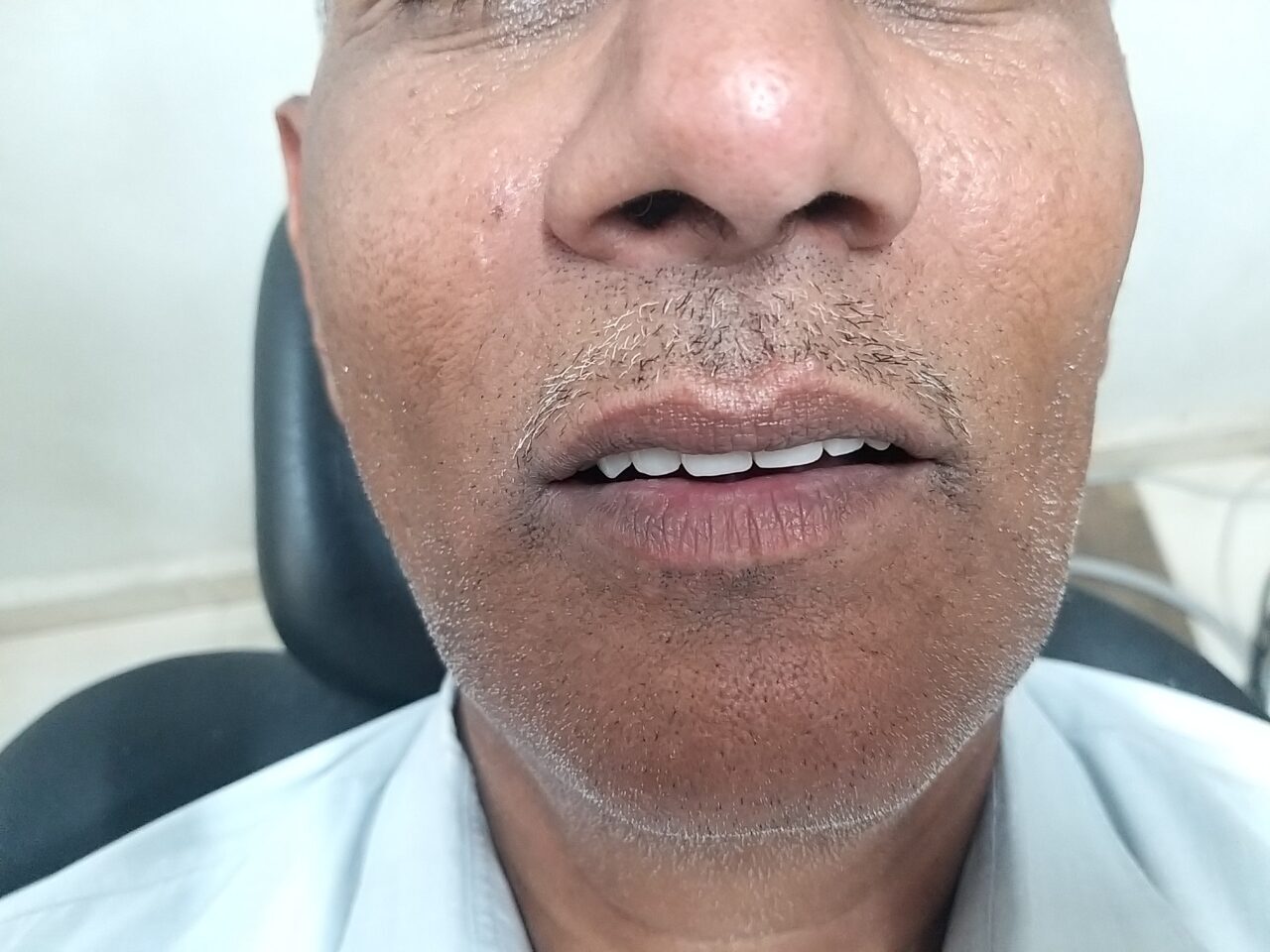 full mouth implant - 2