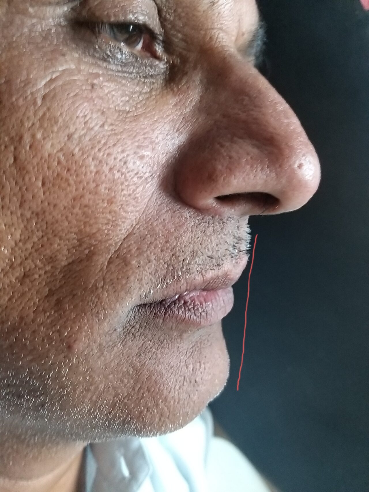 full mouth implant - 4