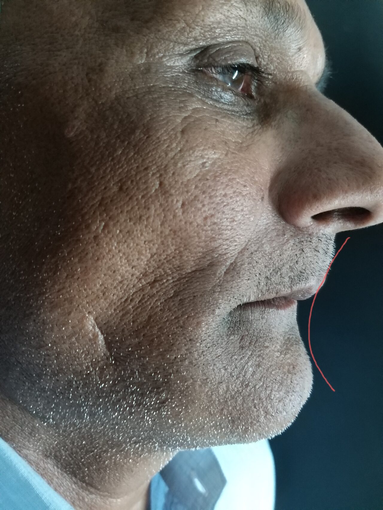 full mouth implant - 5
