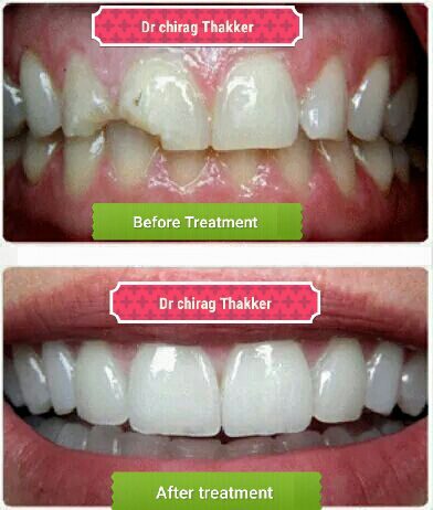 smiledesignwithceramicveneer- 1