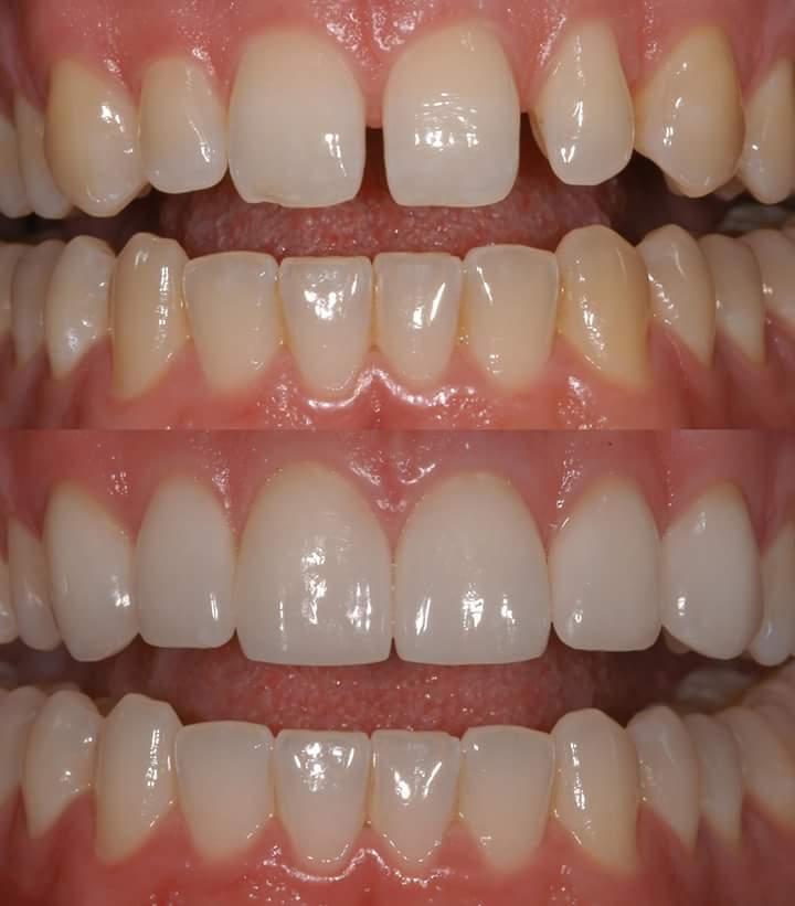 smiledesignwithceramicveneer- 2