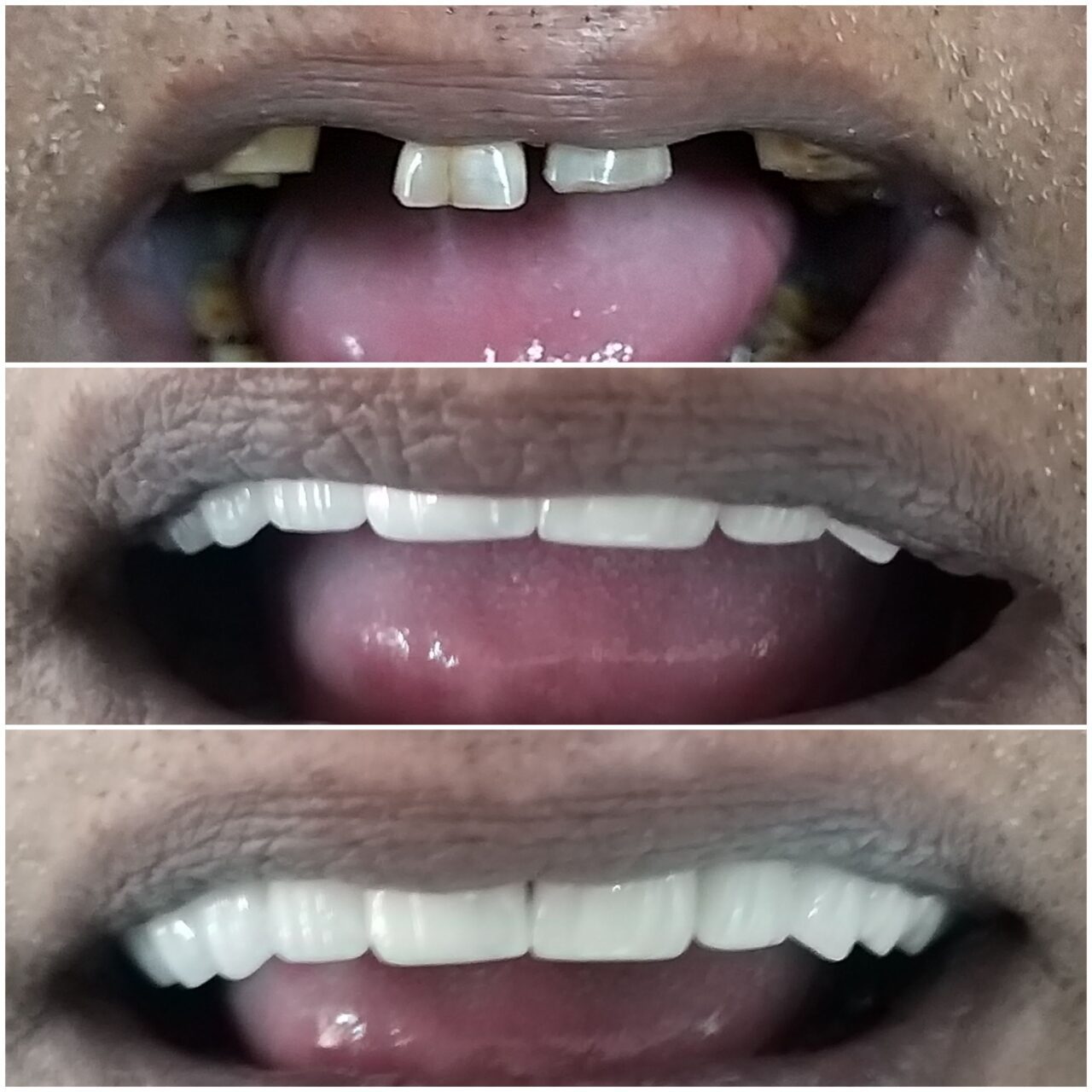 full mouth rehabilitation with ceramic bridge - 2