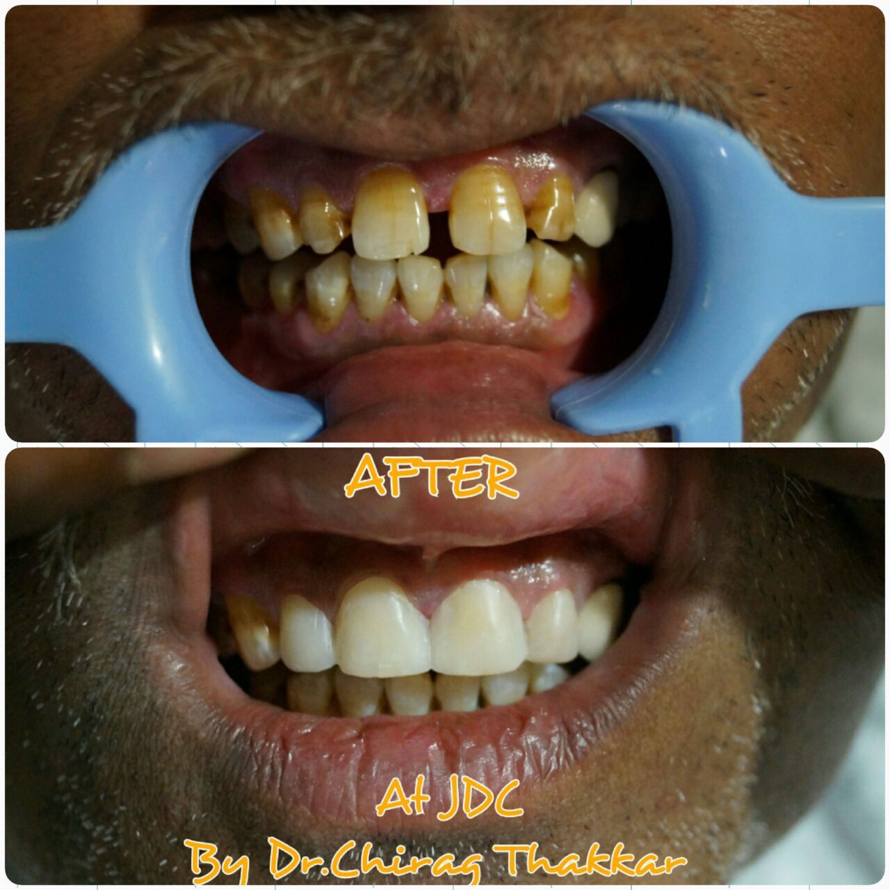 smile corrections with tooth color material compositevenee - 1
