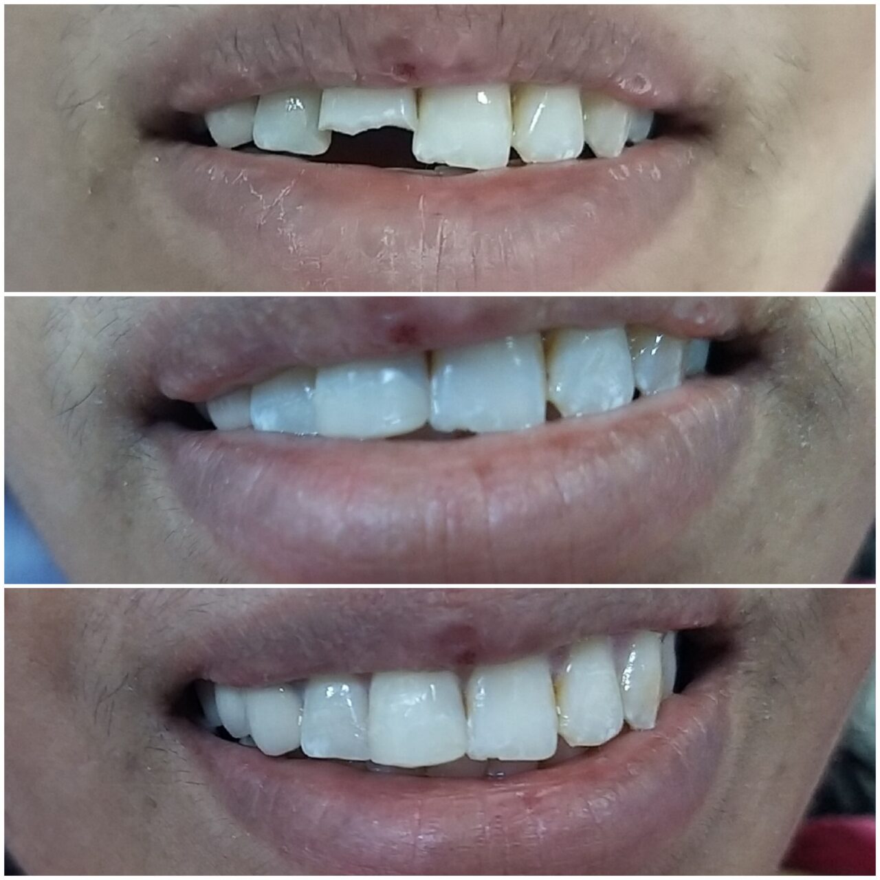 smile corrections with tooth color material compositevenee - 2