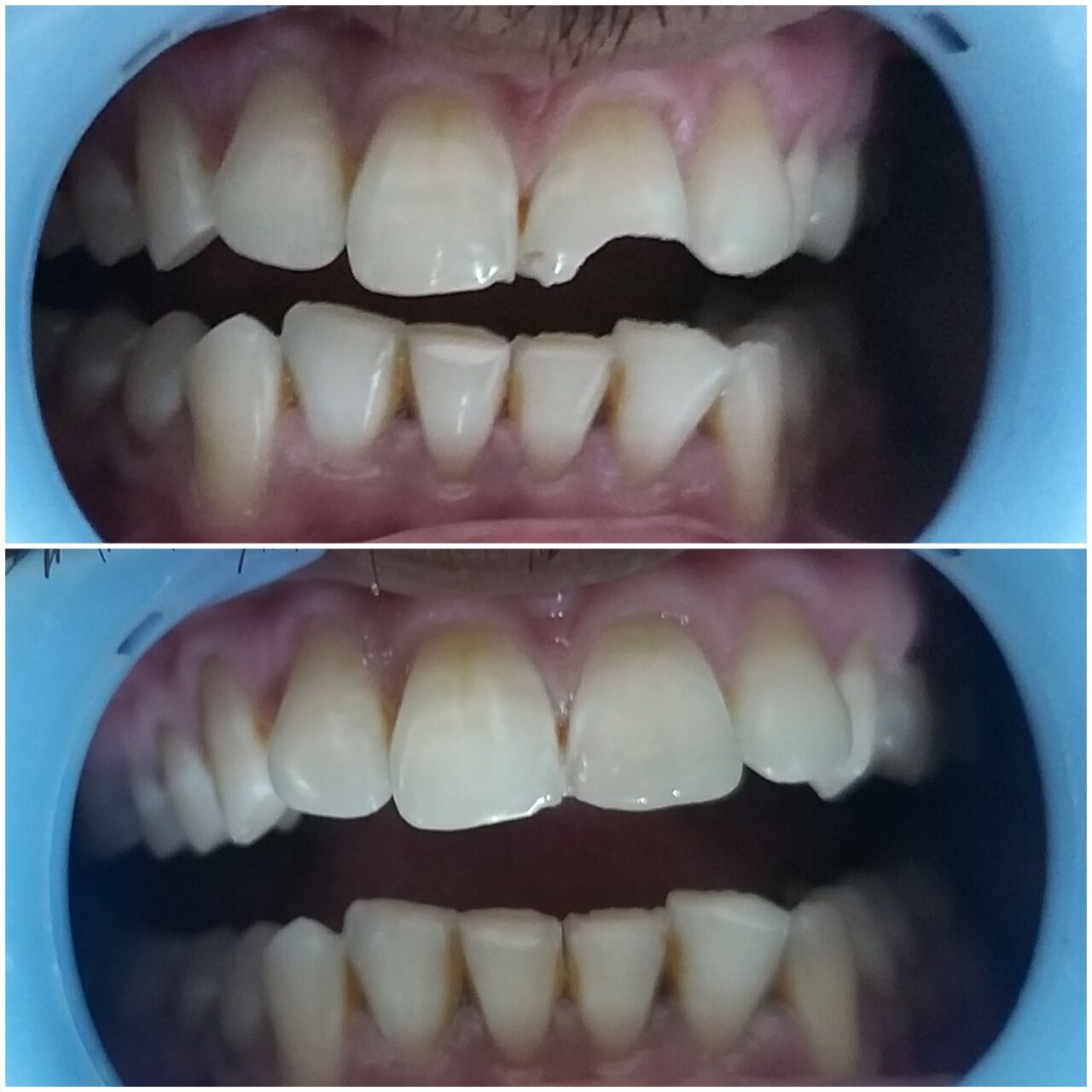 smile corrections with tooth color material compositevenee - 3