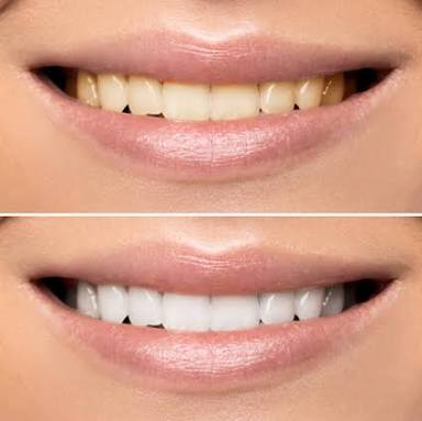 tooth bleaching teeth whitening - 1