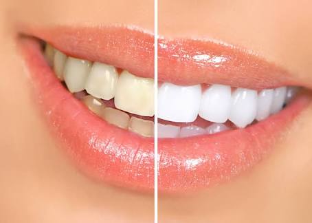 tooth bleaching teeth whitening - 2