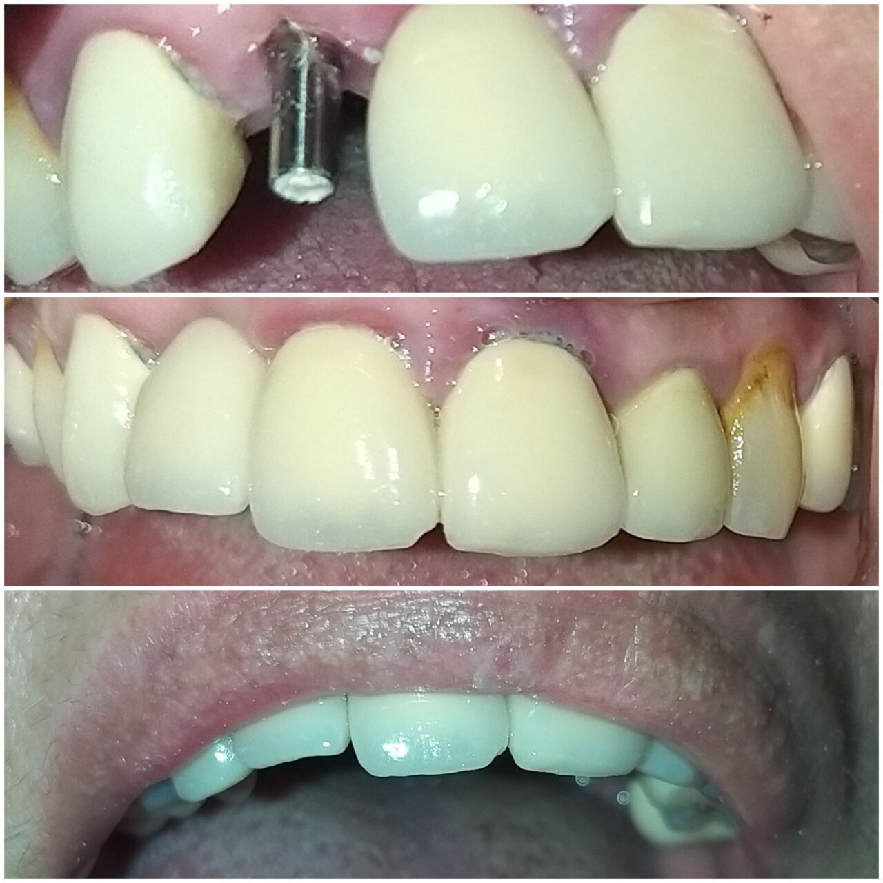 toothreplacementwithsingleimplant - 1