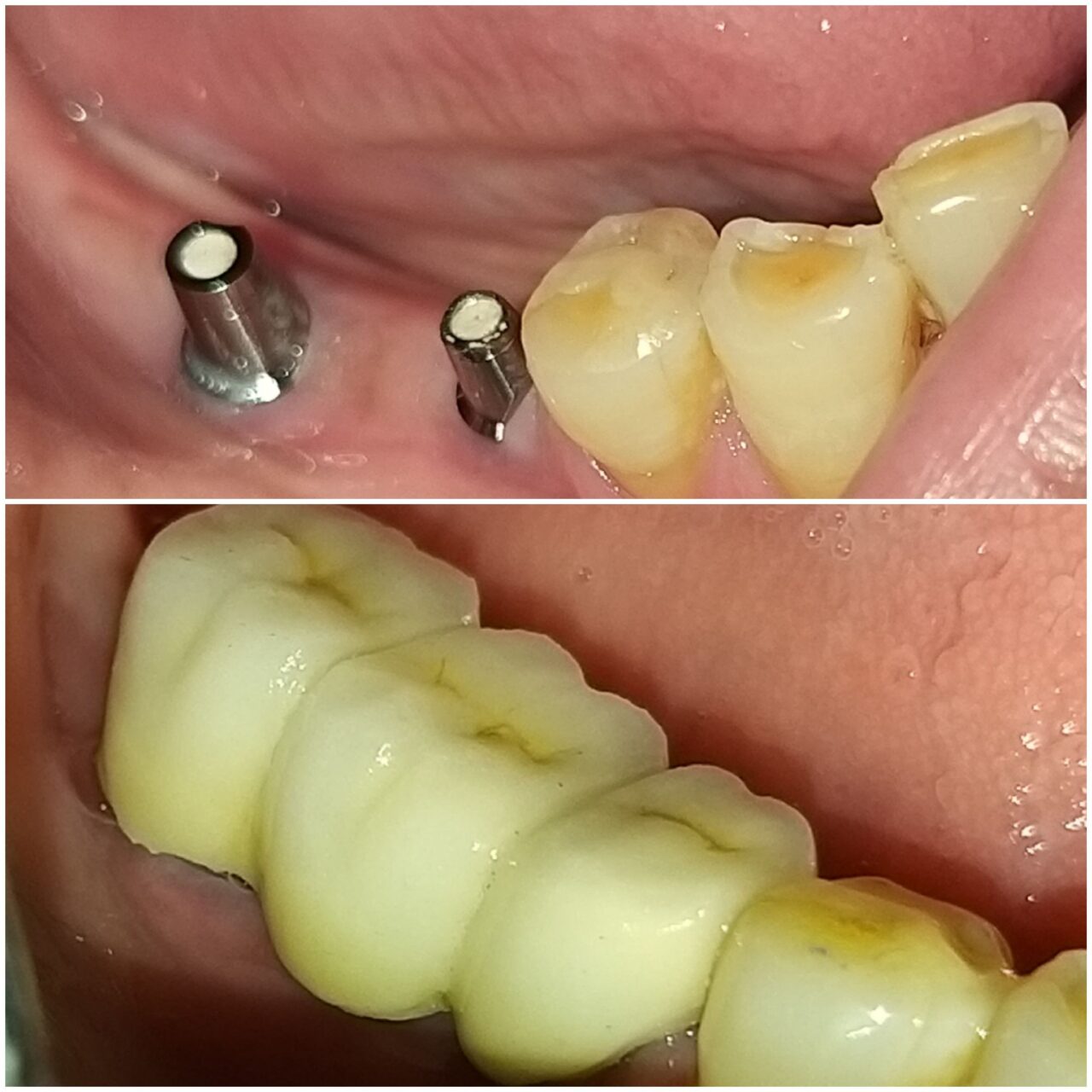 toothreplacementwithsingleimplant - 2