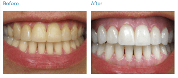 Teeth Whitening Treatment at South Bopal