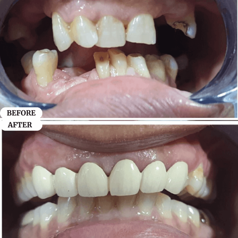 03 perfect smile before after result