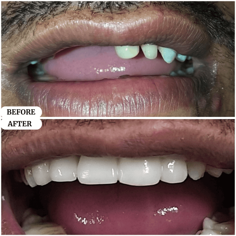 04 perfect smile before after result