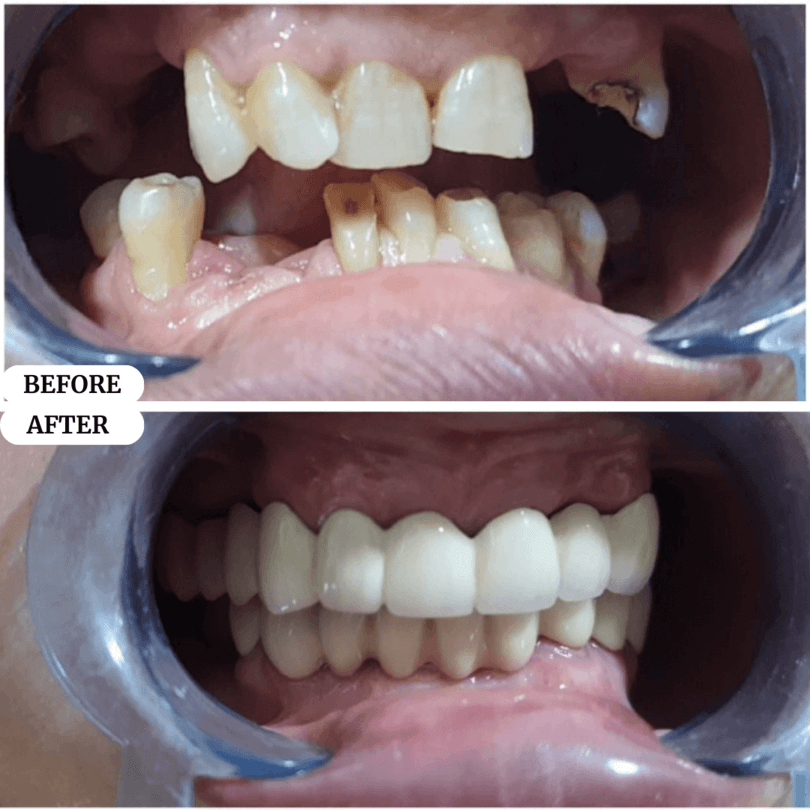 05 perfect smile before after result