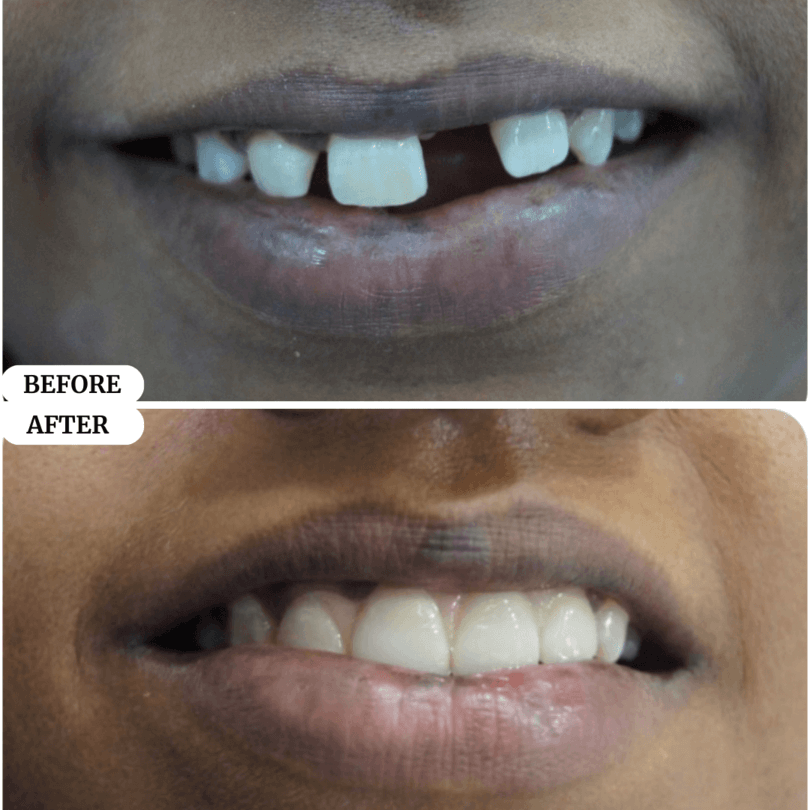 07 perfect smile before after result