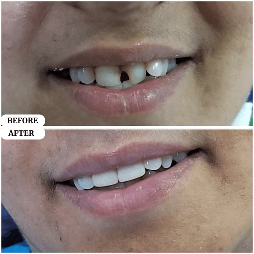08 perfect smile before after result