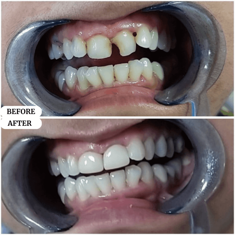 01 perfect smile before after result